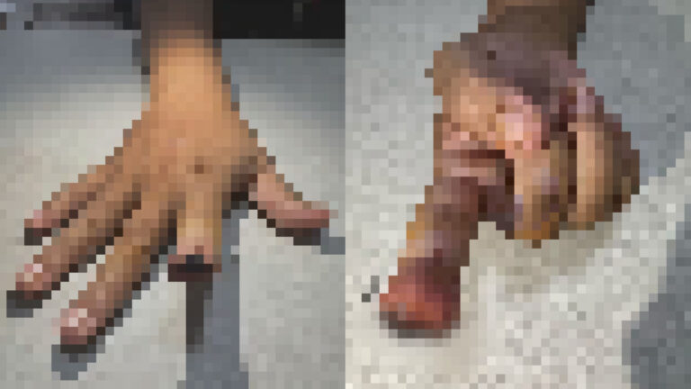 Mulher tem dedo decepado por namorado por ciúmes em Manaus