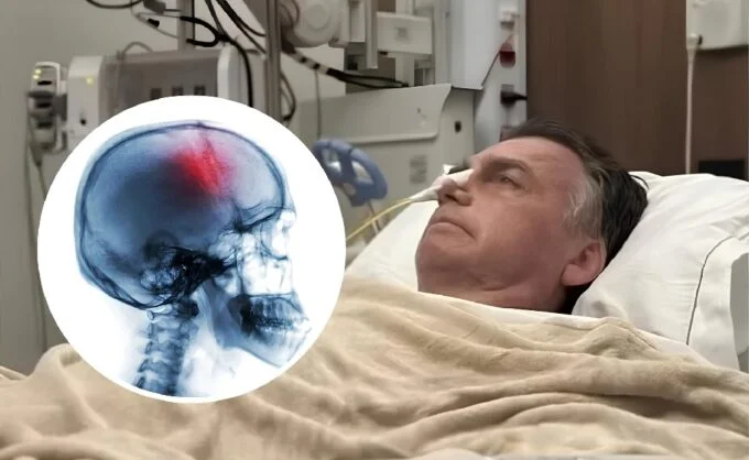 Bolsonaro sofre traumatismo craniano leve após queda em cela da PF, em Brasília
